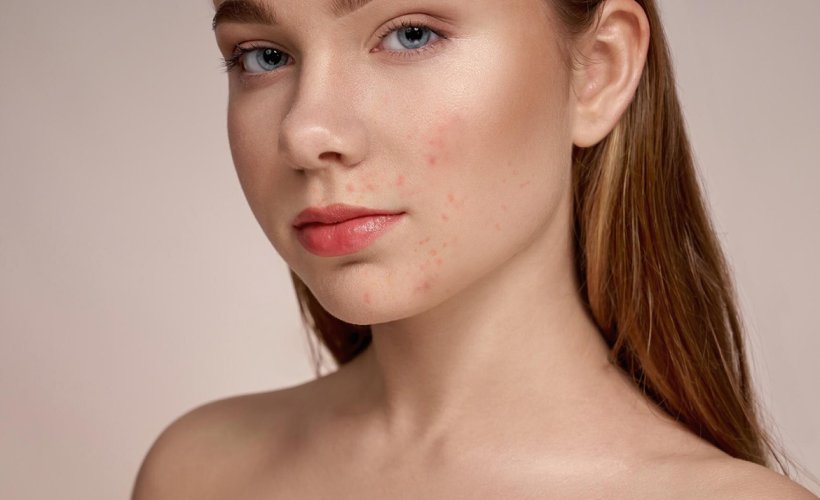 Peau & imperfections